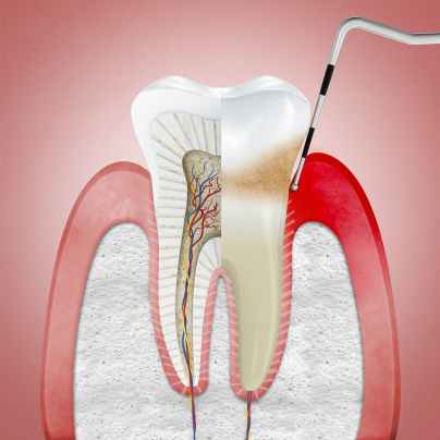 2.3.2_Stages_Gingivitis