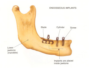 endosseous-implants-300x229