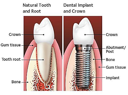 tooth-replacement-option
