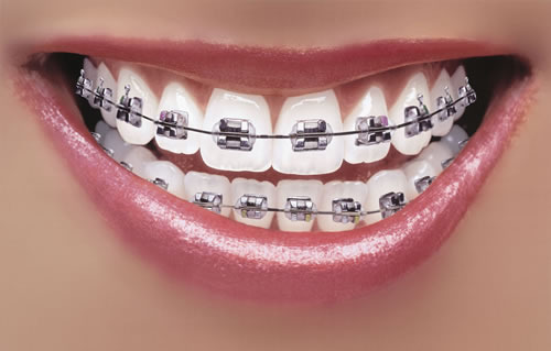 dental-braces-500x500